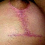 Caso 1. Inicio. Imagen de primer plano de la piel en la zona del seno que muestra una cicatriz hipertrófica y de color enrojecido