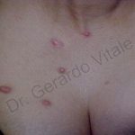 Caso 10. Inicio. Imagen de la piel del pecho donde se observan elementos enrojecidos de formas ovaladas y voluminosos