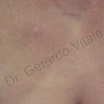 Caso 10. Final. Imagen de la zona del pecho con foco en la piel que se observa bronceada y sana con cicatrices mínimas de forma ovalada