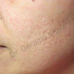 Caso 11. Inicio. Imagen de primer plano de la piel de la mejilla donde se aprecia la superficie irregular