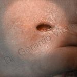 Caso 12. Inicio. Imagen de primer plano de una herida en forma circular en la parte superior del pie con la piel alrededor con tejido cicatrizado siendo apuntada con una luz en forma circular