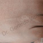 Caso 12. Final. Imagen de primer plano de la parte superior de un pie en el que muestra una herida cicatrizada luego de un tratamiento