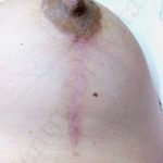 Caso 2. Final. Imagen de primer plano de la zona del seno con foco en la piel por recuperación de la cicatriz con zonas blanquecinas