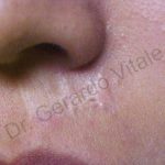 Caso 9. Inicio. Imagen de la piel de la zona nasal donde se aprecia una cicatriz hipertrófica de bordes irregulares