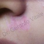 Caso 9. Final. Imagen de la zona nasal donde se aprecia la piel enrojecida en sanación