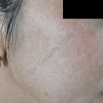 Imagen de la piel de la mejilla se aprecia mejoría de color se ve uniforme