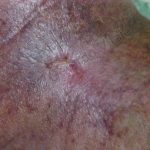 Imagen de la piel del pie, cara superior se aprecia cicatriz de color rojiza