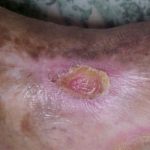 Imagen de primer plano lesión ovalada con fondo rosado