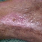 Imagen de primer plano de cicatriz de color rosada en recuperación