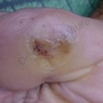 primer plano de pie con herida cicatrizada