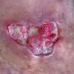 Primer plano de la piel de una persona que muestra la textura y los detalles de la carne, con signos visibles de una lesión.