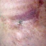 primer plano de piel con herida cicatrizada y zonas de color rojo oscuro y blanquecinas