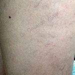 Imagen de la parte superior de la pierna se observa en la superficie de la piel varices de color oscuro