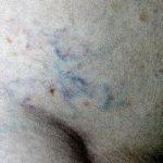 Imagen de primer plano de la piel se observa en la superficie varices de color oscuro