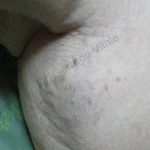 Imagen de la piel se observa disminución de las varices