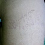 Imagen de la piel de la pierna porción superior se aprecia en la superficie de la piel varices de color oscuro