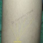 Imagen de la piel de la pierna se aprecia mejoría en al superficie de la piel y desaparición de várices