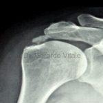 Caso 2. Bursitis. Imagen de color negro con sombras de estructuras oseas de la articulación del brazo