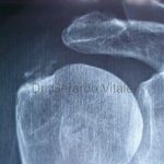 Caso 1. Bursitis. Imagen de color negro con sombras de estructuras oseas de la articulación del brazo, disolución en progreso de la calcificación