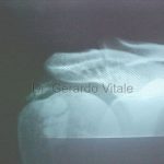 Caso 3. Bursitis. Imagen de color negro con sombras de estructuras oseas con disminución de calcificaciones