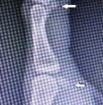 Caso 4. Imagen oscura con sombras oseas de la articular a nivel del dedo pulgar con calcificaciones por bursitis