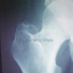 Caso 5. Imagen de disolucion de calcificación por Bursitis a nivel de la articulación de la cadera