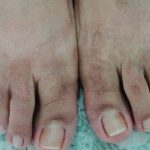 Caso 5.Final. Imagen de la parte superior de los pies con enfoque en la piel después de tratamiento por dermatitis