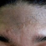 Caso 1. Inicio. Imagen de primer plano de la piel de la zona de la frente donde se observan enrojecimiento de la superficie