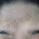 Caso 1. Final. Imagen de primer plano de la piel de la zona de la frontal se aprecia la piel sana