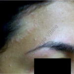 Caso 11. Inicio. Imagen del rostro donde se aprecia lesión ovalada en piel con un color más rojizo que la piel sana