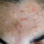 Caso 2. Inicio. Imagen de la piel de la zona frontal, donde se aprecia en la superficie lesiones en disposición irregular de color enrojecido