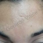 Caso 2. Final. Imagen de la piel de la zona frontal, donde se aprecia en la superficie lisa y sana