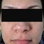 Caso 3. Final. Imagen del rostro, donde se aprecia la piel del mentón sana