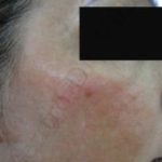 Caso 4. Inicio. Imagen de perfil derecho la piel se aprecia con una superficie enrojecida
