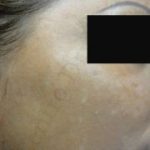 Caso 4. Final. Imagen de perfil derecho la piel se aprecia con una superficie sana