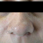 Caso 6. Imagen de la piel del rostro se observa la superficie sana