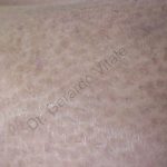 Caso 7. Inicio. Imagen de primer plano de la piel donde se aprecia piel de aspecto oscuro de superficie lisa