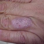 Caso 8. Inicio. Imagen de la piel de la base del dedo anular donde se aprecia una lesión escamosa de color rosada