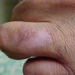 Caso 8. Final. Imagen de la piel de la base del dedo anular donde se observa una cicatriz blanquecina después del tratamiento