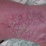 Caso 9. Inicio. Imagen de lesión en piel de color rojizo y con rastro de escamas