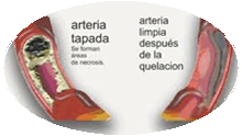 Imagen esquemática que muestra el antes y después de una arteria que estuvo obstruida y luego se corrigió el proceso por la terapia de quelación