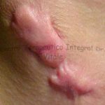 Caso 3, Inicial. Queloide Secundario a Quemadura, en cuello